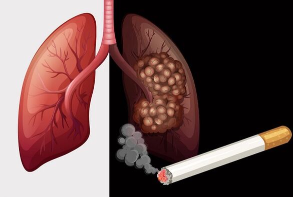 plămânii fumătorului și plămânii sănătoși